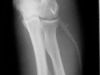 8 pasos para prevenir la osteoporosis