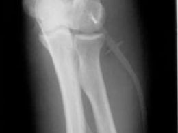 8 pasos para prevenir la osteoporosis