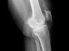 Síntomas de la osteoporosis