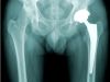 Implantación de una prótesis de cadera