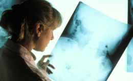 ¿Qué es la estenosis lumbar?