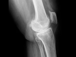 Síntomas de la osteoporosis
