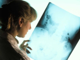 ¿Qué es la estenosis lumbar?