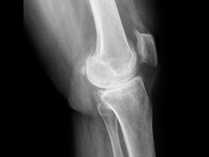 Síntomas de la osteoporosis
