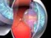 Así se produce un glaucoma