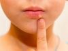 ¿Por qué salen los herpes?