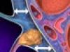 Así se produce un derrame pleural