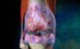 ¿Qué es la osteoartritis?