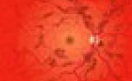 ¿Qué es la retinopatía diabética?