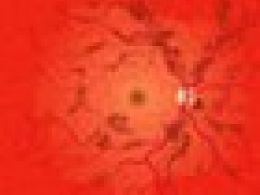 ¿Qué es la retinopatía diabética?
