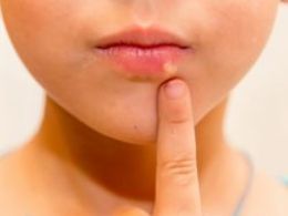 ¿Por qué salen los herpes?