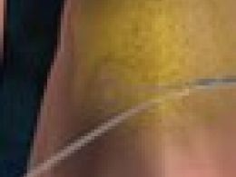 ¿Cómo se realiza una liposucción?