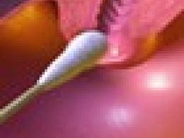 ¿Qué es la displasia cervical?