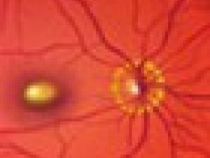 ¿Por qué se produce la degeneración macular?