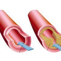 Arteria anormal