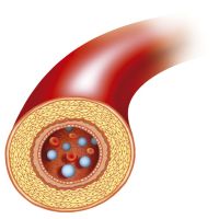 Ateroma arterial