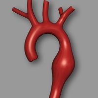 Disección aorta