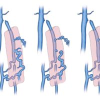 Varices