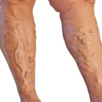 Varices agrupadas
