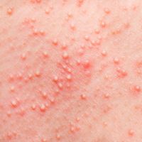 Alergia