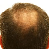 Alopecia