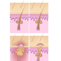 Bulbo piloso
