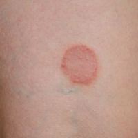 Dermatofitosis