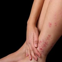 Eczema