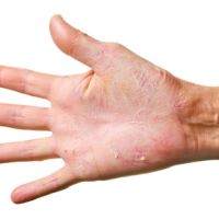 Eczema al frío