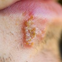Herpes