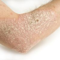 Psoriasis