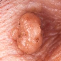 Verrugas