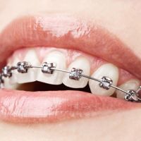 Aparato dental fijo