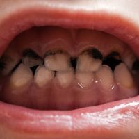 Gingivitis