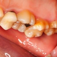 Placa bacteriana