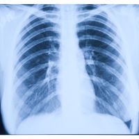 Radiología de los pulmones