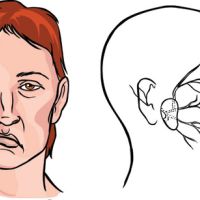Parálisis facial