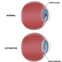 Catarata