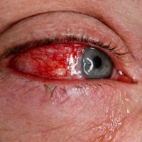 Derrame ocular