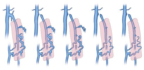 Varices