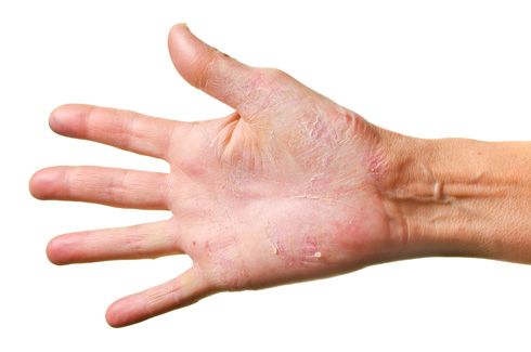 Eczema al frío