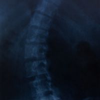 Escoliosis