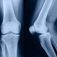 Radiografía de rodilla