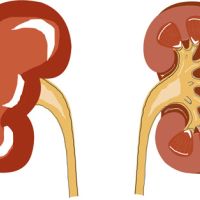 Pelvis renal